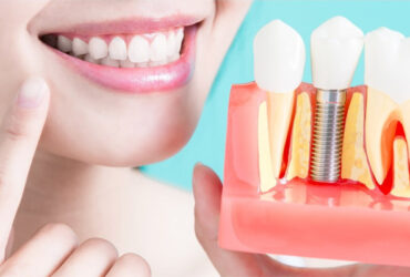 Dental Implants