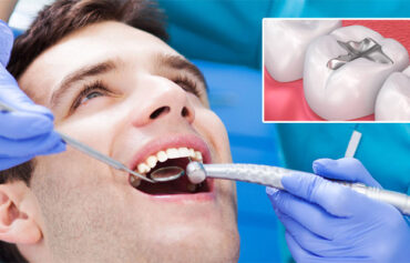 Dental Filling