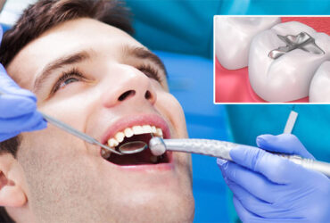 Dental Filling