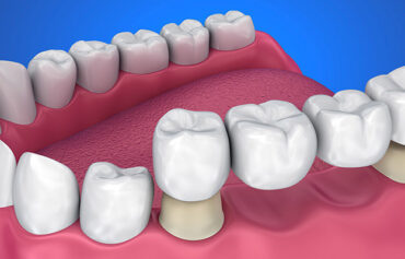 Dental Bridges