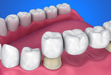 Dental Bridges