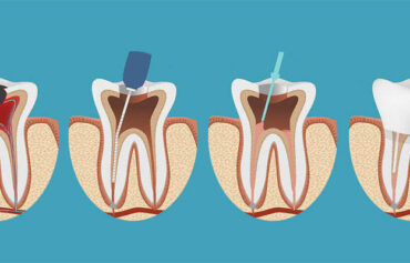 Root Canal Treatment