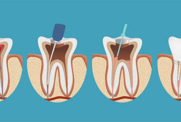 Root Canal Treatment